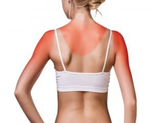 HarrisDermsun burn 300x242 1