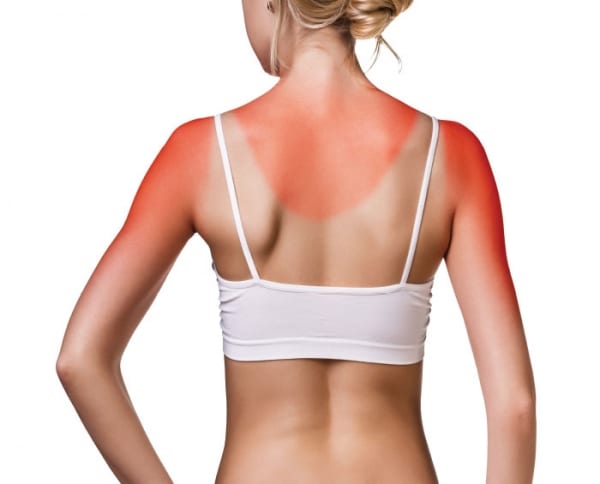 HarrisDermsun burn