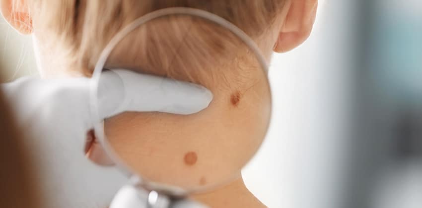 Skin biopsy Naples FL