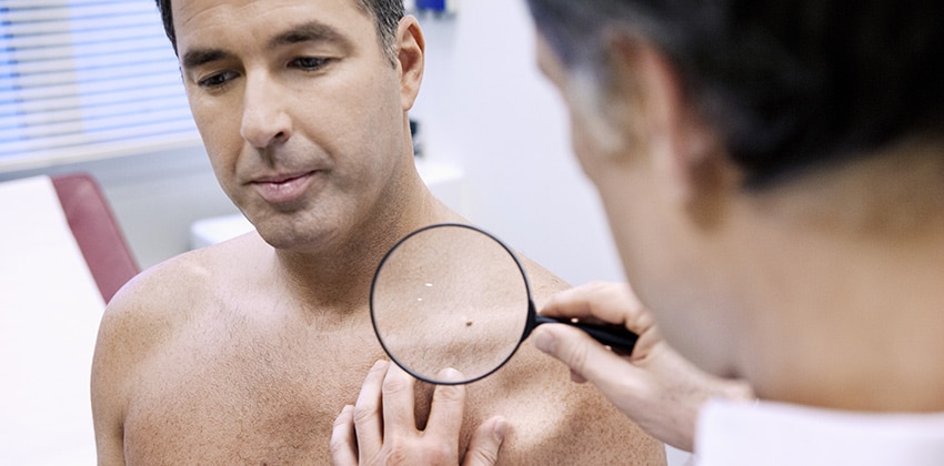 Squamous Cell Carcinoma Naples
