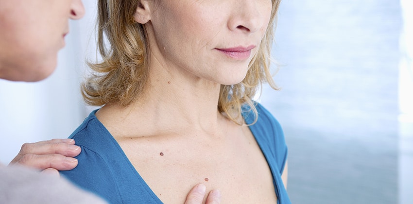 Melanoma Treatment Naples FL