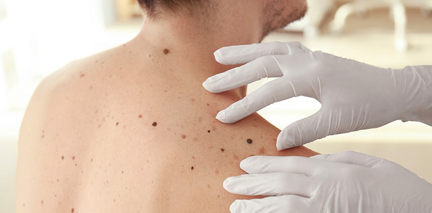 Mole Removal Naples FL