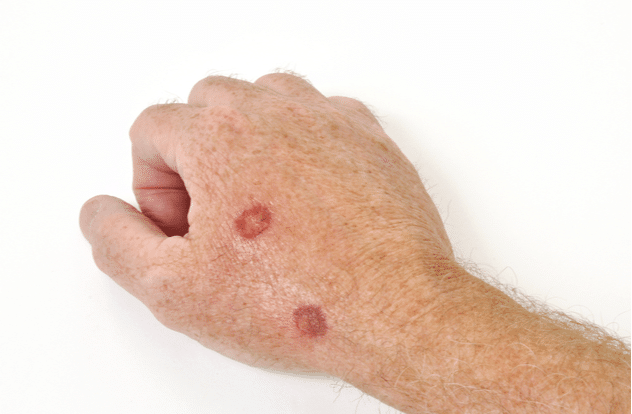 Cryotherapy treatment to remove precancerous cells from a hand