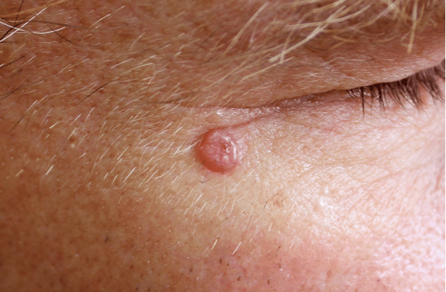 A case of nodular basal cell carcinoma