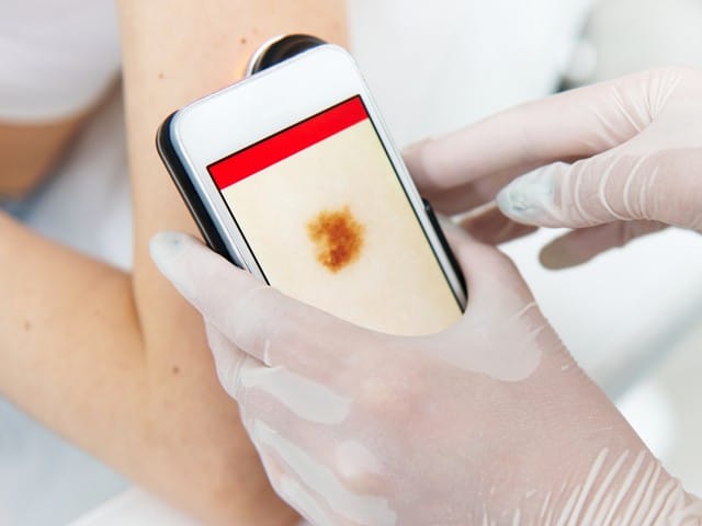doctor's hand in medical gloves holding a dermoscope and examining moles