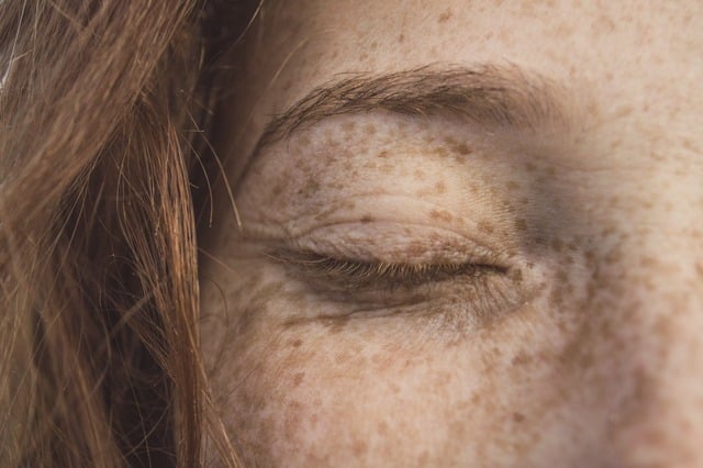 Skin Cancer