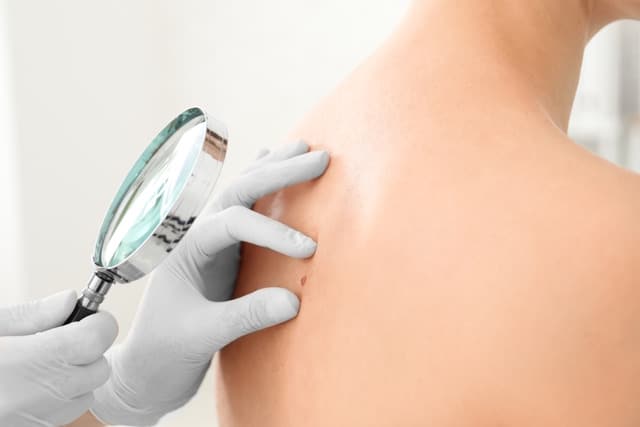 skin cancer