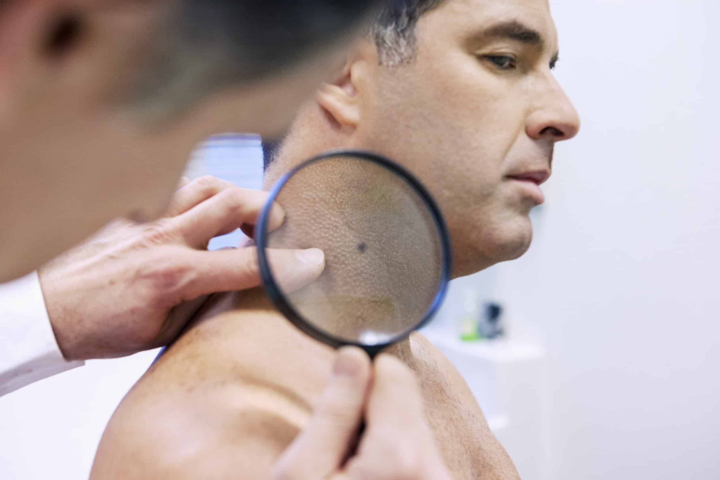 Squamous Cell Carcinoma Fort Myers