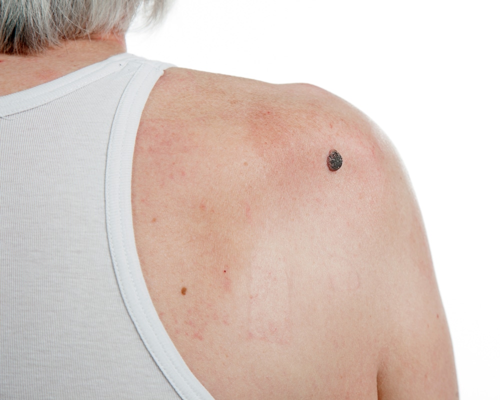 Squamous cell carcinoma on a persons’s shoulder, treatable with Mohs surgery