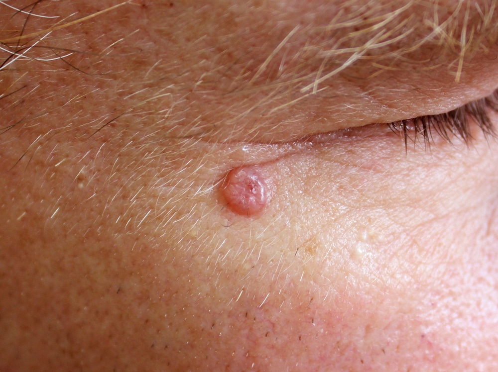Close up of basal cell carcinoma on man’s face, treatable with Mohs surgery