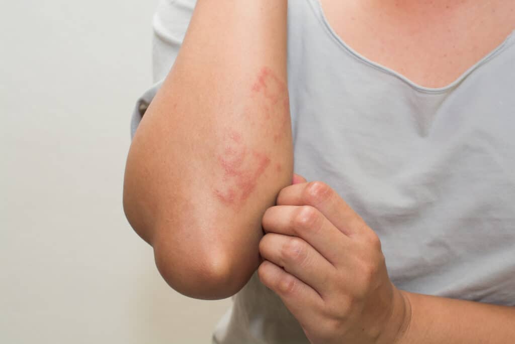 A close-up shot of the elbow of someone with psoriasis