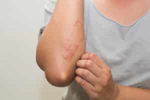 A close-up shot of the elbow of someone with psoriasis