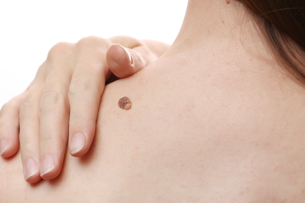 A close-up of a woman with a prominent mole on her back, highlighting the need for cosmetic mole removal to enhance her appearance and boost confidence.