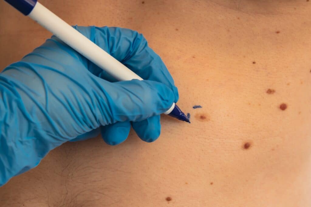 Doctor wearing medical gloves marking lines around male patient’s birthmarks before laser skin tag removal and melanoma prevention exam