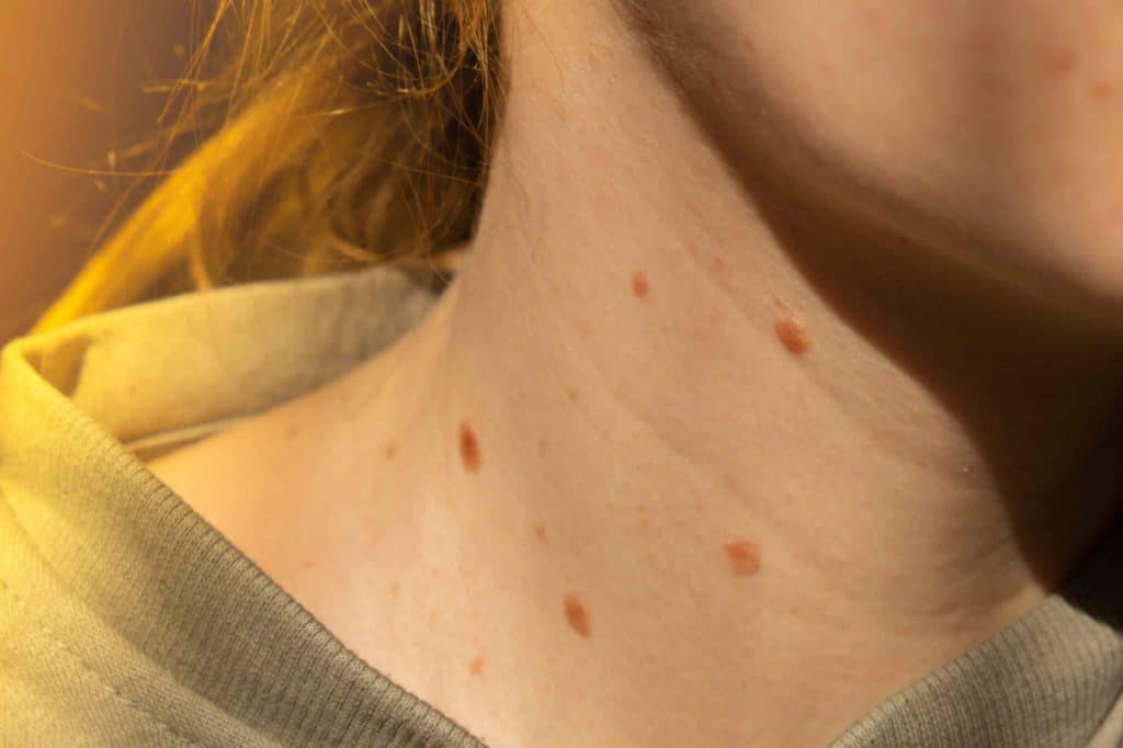 Close up of a patient showing a large, dark mole and standing in the sun, possibly a melanoma.