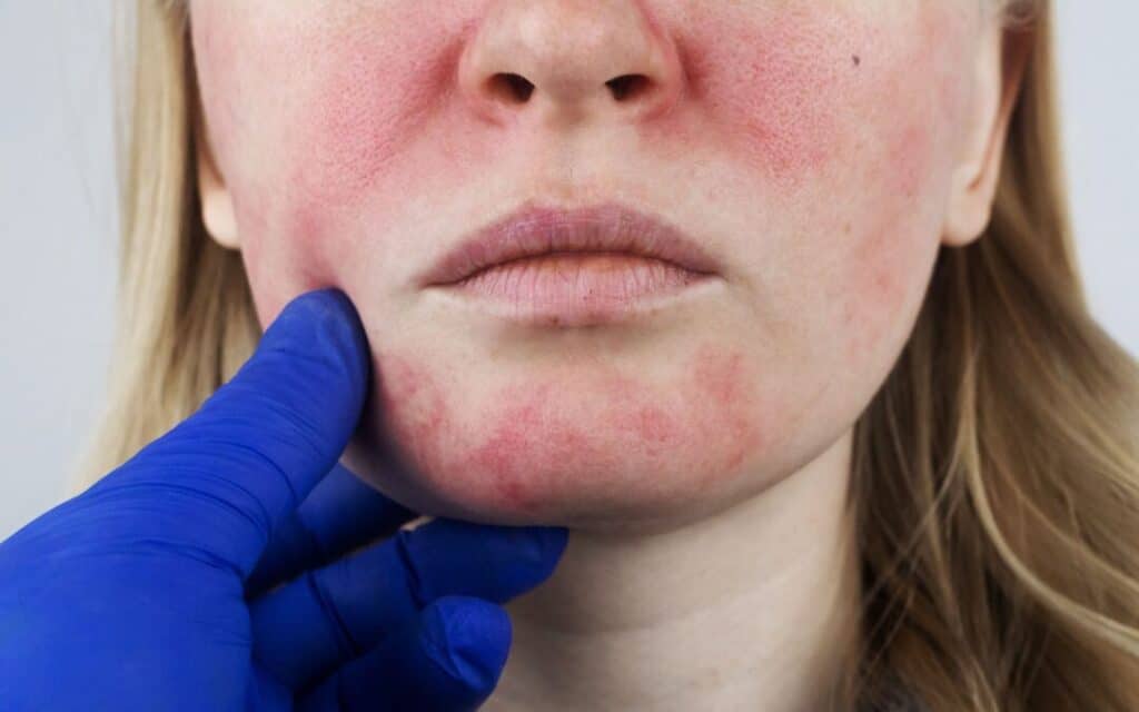 Rosacea Triggers And Treatment In Naples, FL - Harris Dermatology
